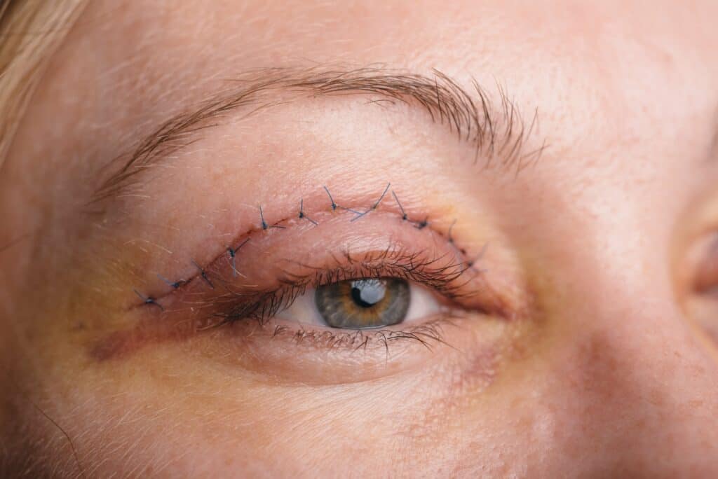 blepharoplasty-upper-eyelid-operation-that-removes-excess-ugly-skin-eyelids-eyes-photos-show-seams-this-is-third-day-after-operation-min