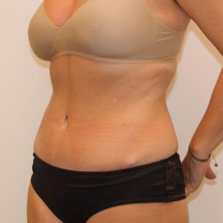 maveplastik_efter1-450x450